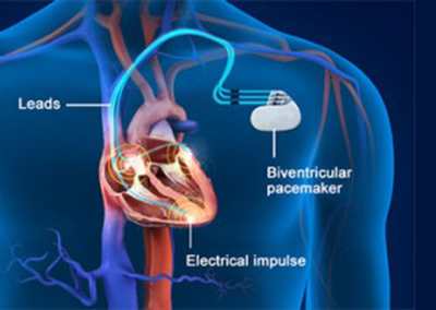 Temporary And Permanent Pacemaker Implantation