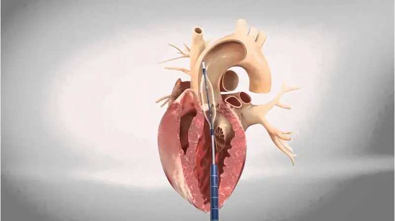 TAVI-TAVR Surgery